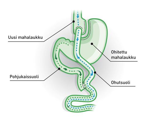 Mahalaukun_ohitusleikkaus_gastric bypass.JPG