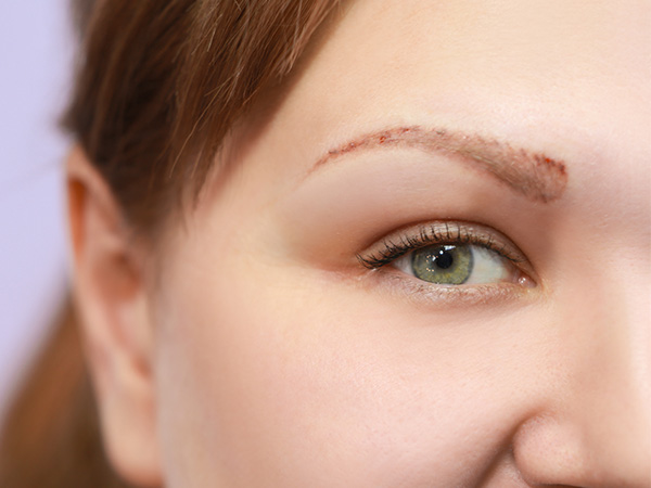 Microblading- ja kestopigmentoitujen kulmien poisto laserilla Eiran sairaalassa.