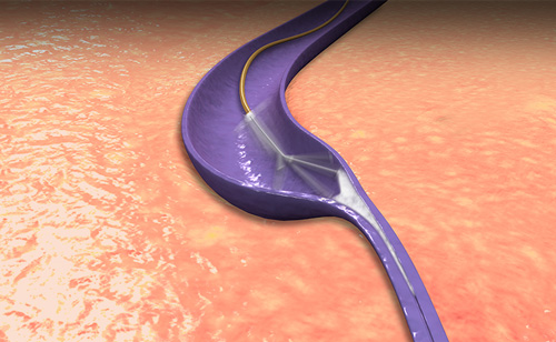 ClariVein_500x308.jpg