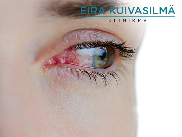 Kuivasilmäklinikka_600x450.jpg
